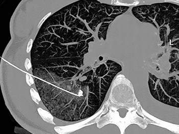 Lungenmarker CT