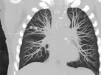 Lungenmarker CT
