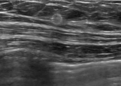 Brusttumor Lokalisation, Clipmarkierung, biopsy site marker