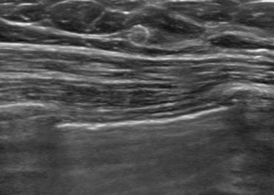 Brusttumor Lokalisation, Clipmarkierung, biopsy site marker