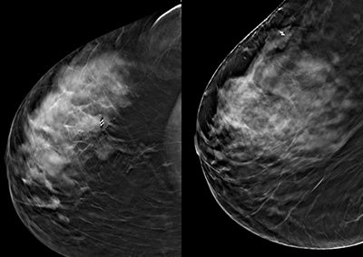 SOMATEX Breast Localization Tumark Vision