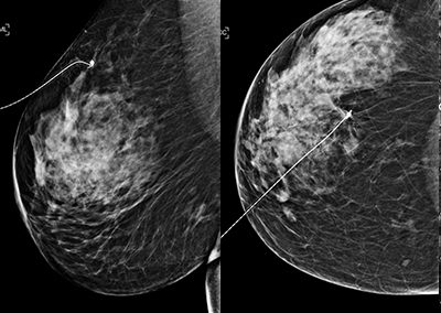 SOMATEX Breast Localization