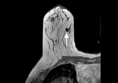 SOMATEX Breast Localization Tumark Vision